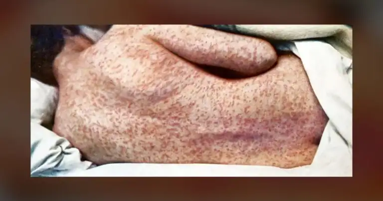 Boise Airport Measles Exposure Affects Over 3,000 Travelers with No Immediate Health Advisory Issued