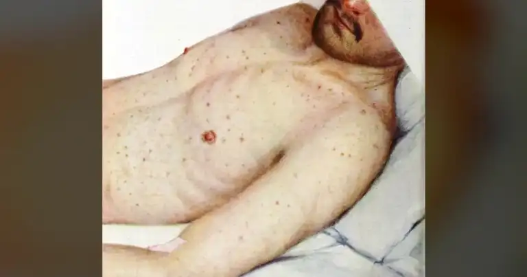 600% Spike in California Typhus Cases Exposes Urban Neglect Crisis