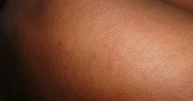Measles Was Eliminated in MD—Now MDH Hunts New Case.
