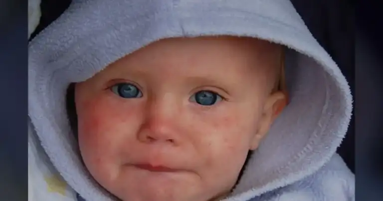 26 Years After Elimination, Measles Returns to RI