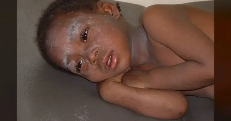 121 New Measles Cases in 3 Weeks: Utah's Crisis Deepens