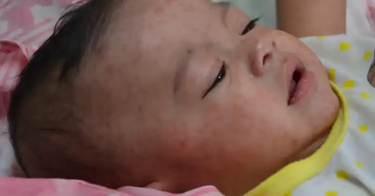 Officials: "More dangerous stage" as WA measles hits 40 in 2026